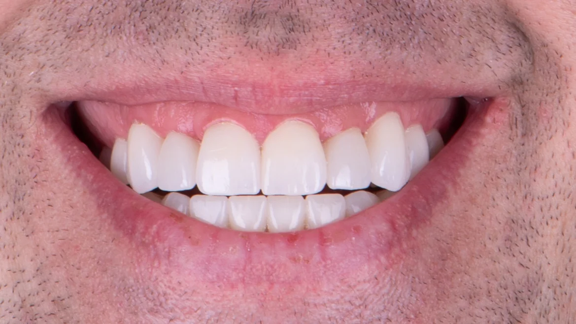 After — Full mouth reconstruction