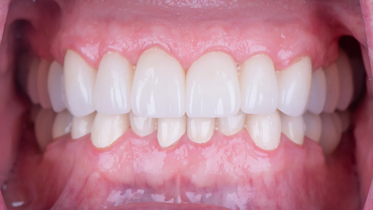 After — Full mouth reconstruction