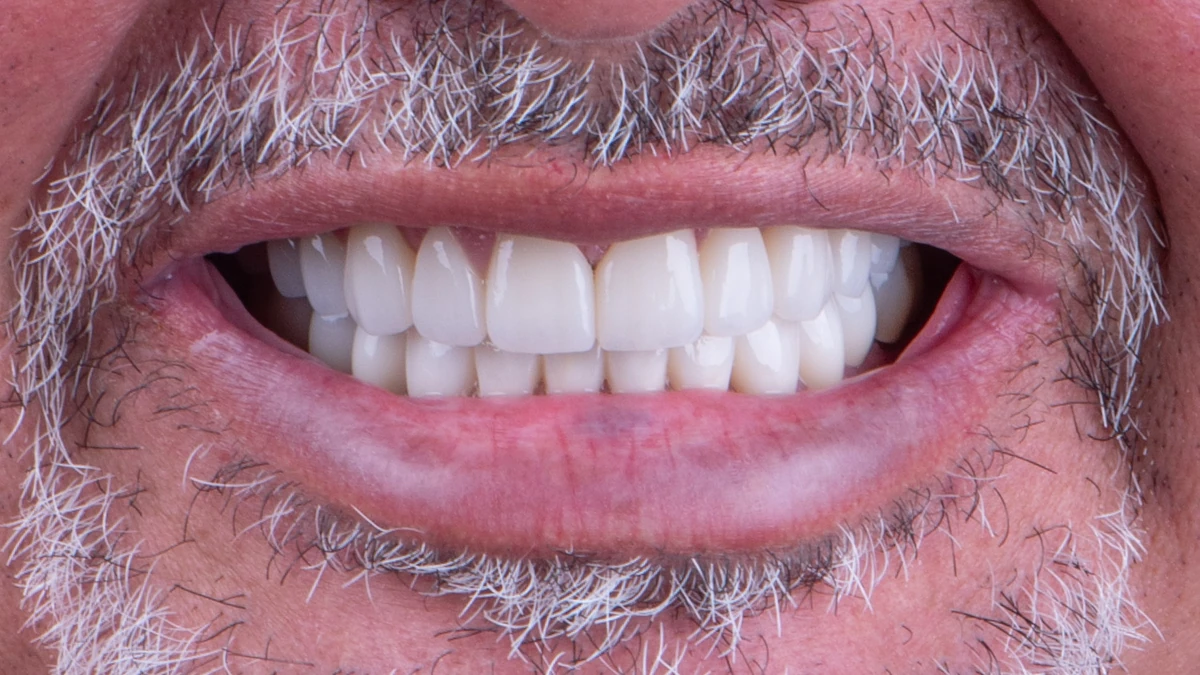 After — Complete smile transformation