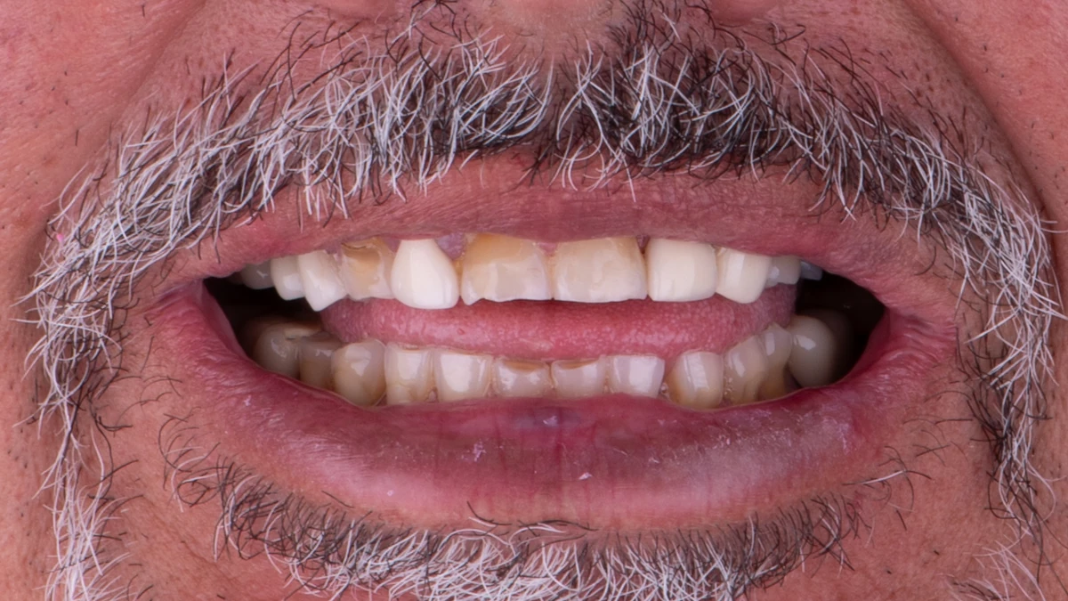 Before — Complete smile transformation