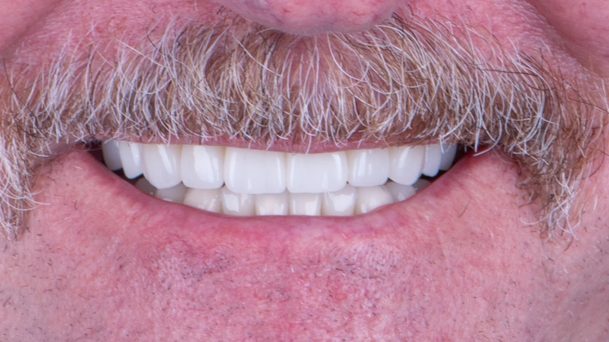 After — Michael's smile transformation