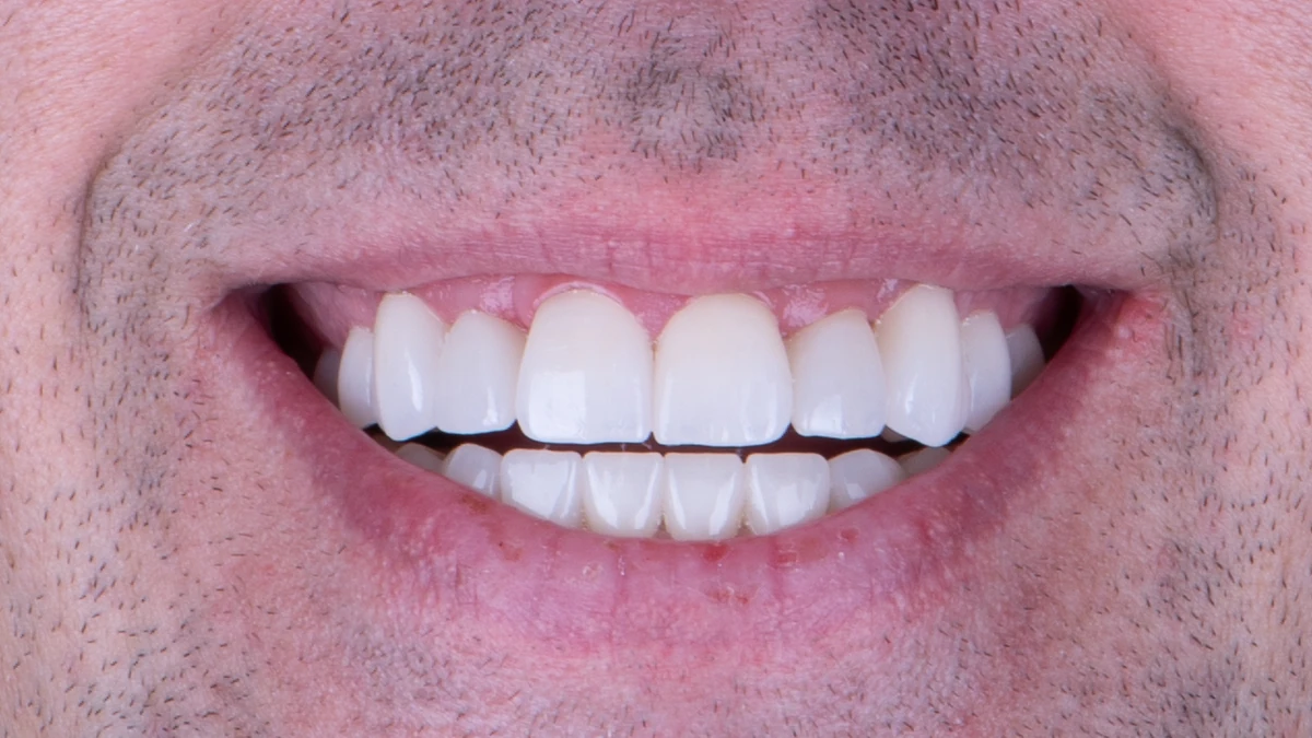 After — Patrick's smile transformation