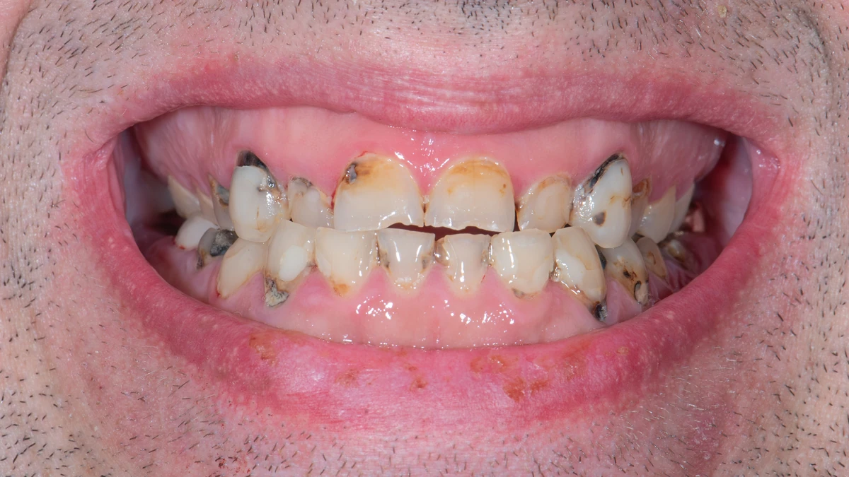 Before — Patrick's smile transformation