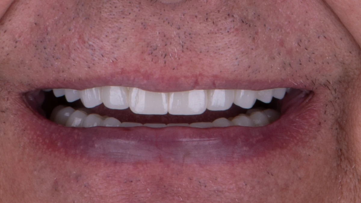 After — Joe's smile transformation