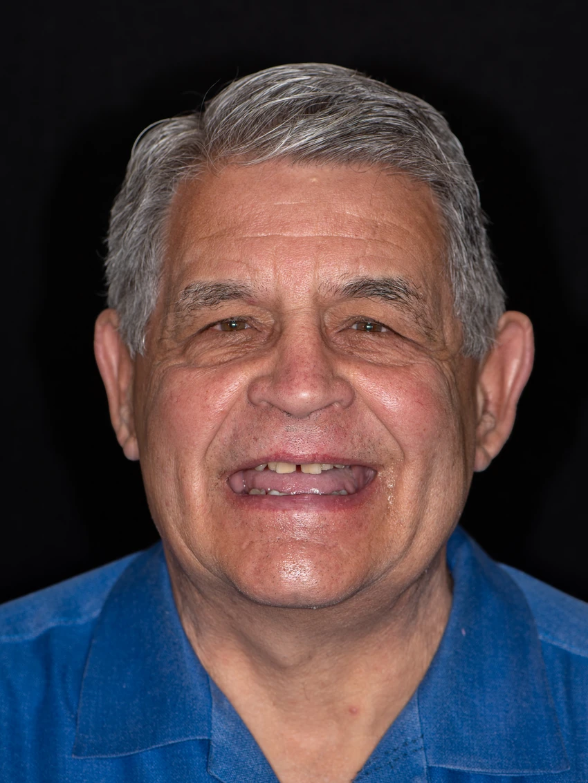 Before — Joe's smile transformation, portrait