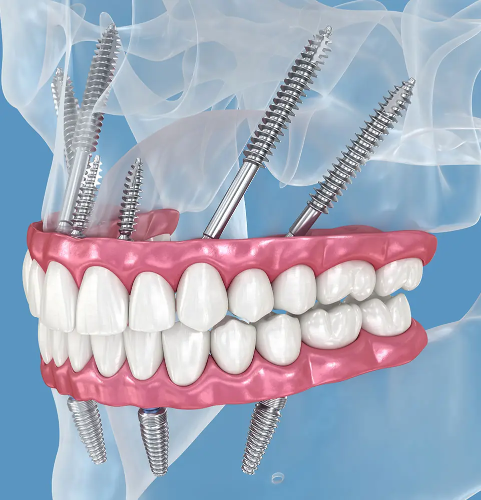 What is Zygomatic Dental Implants