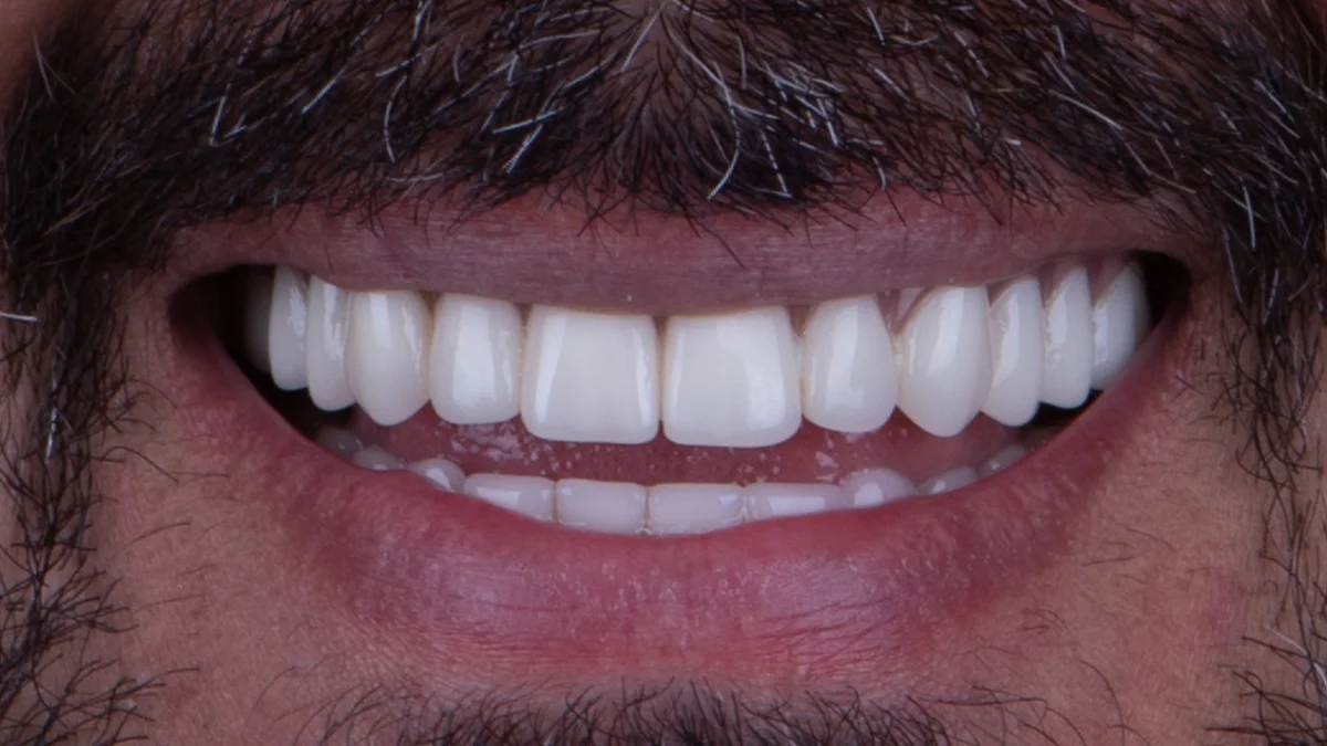 After — Asa's smile transformation