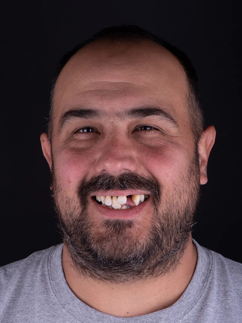 Before — Asa's smile transformation, portrait