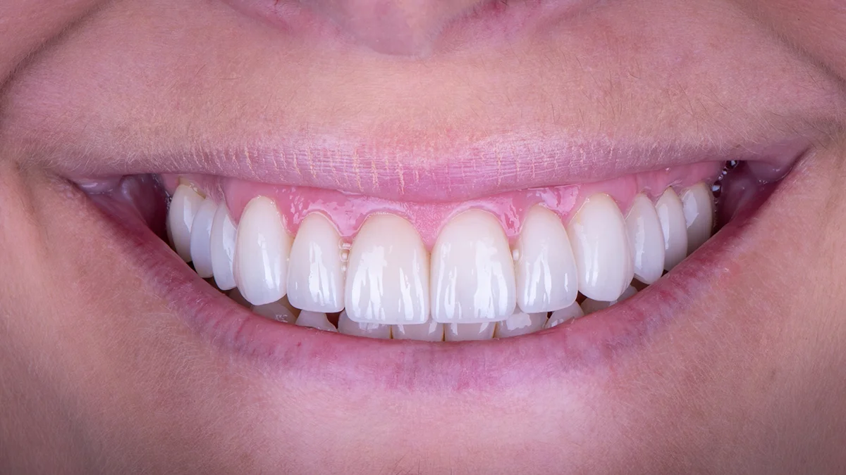After — Briana's smile transformation