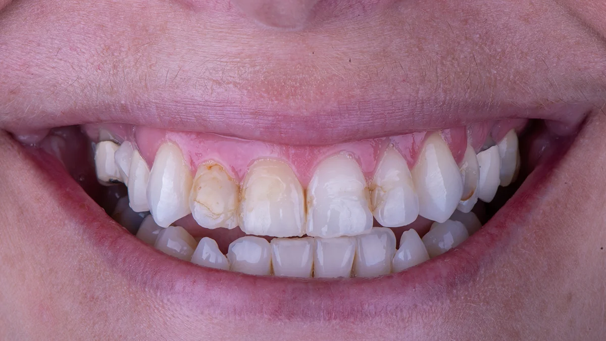 Before — Briana's smile transformation