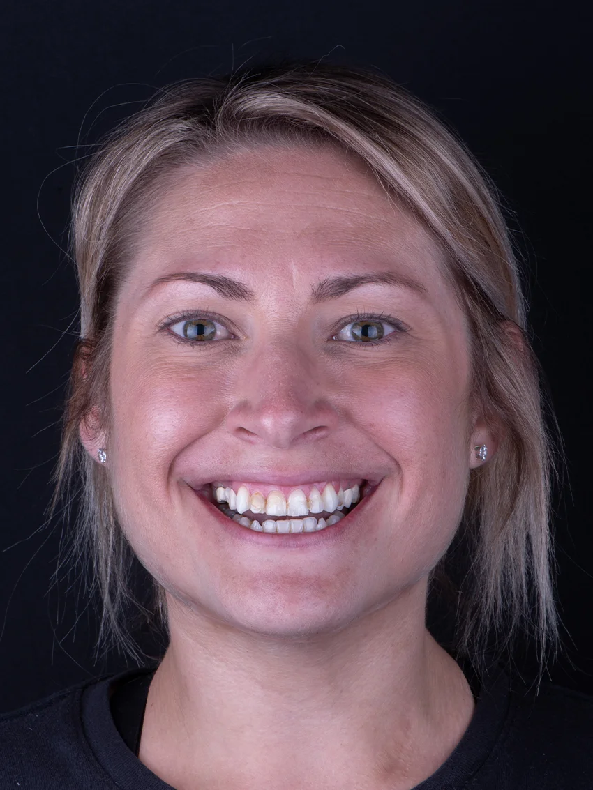 Before — Briana's smile transformation, portrait