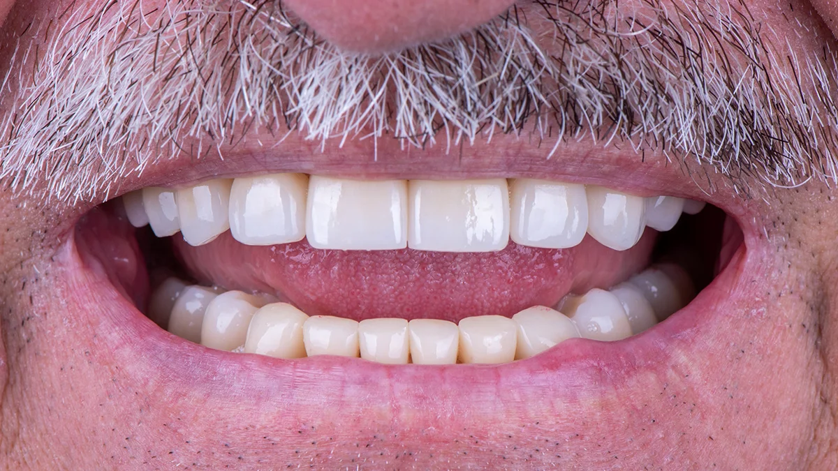 After — David's smile transformation