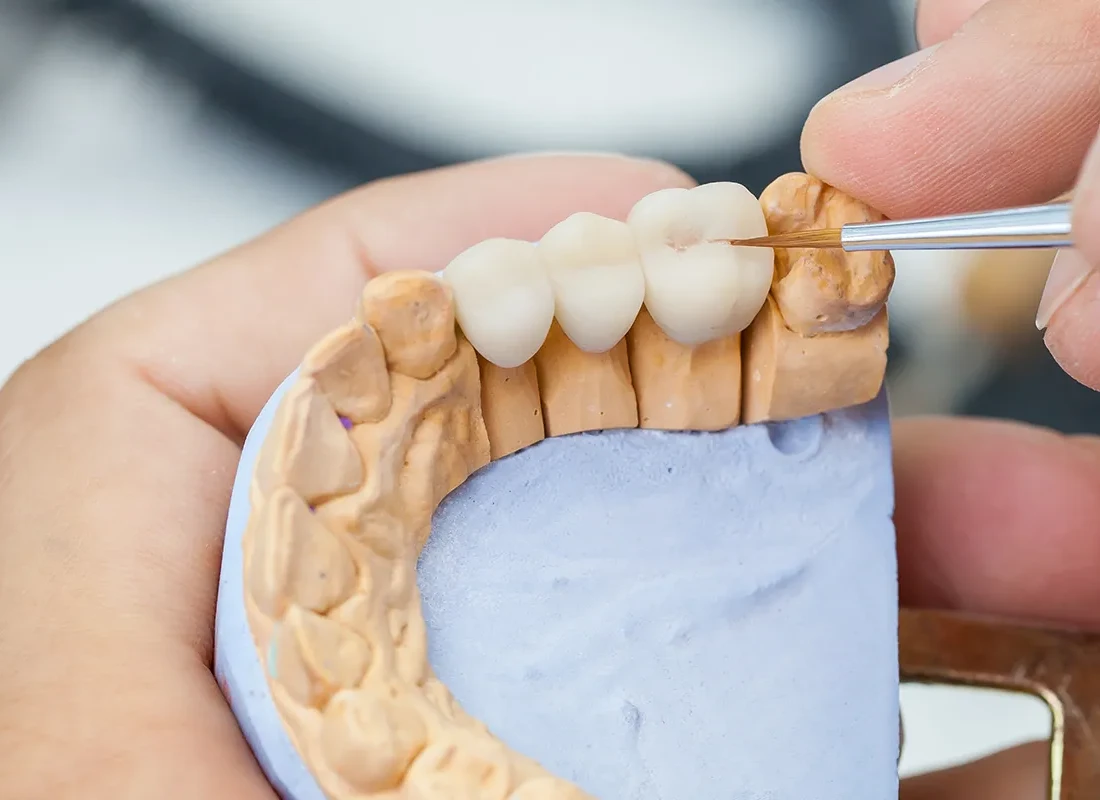 Dental Bridges: Replacing Missing Teeth and Restoring Balance
