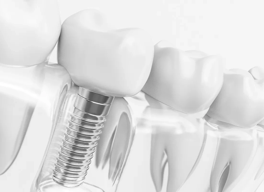 Single Dental Implant