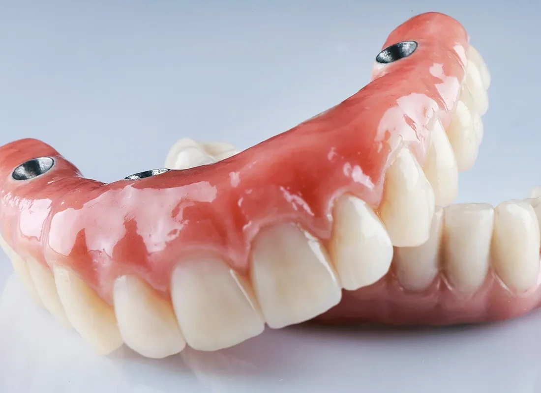 Implants or Dentures? How to Choose the Best Option