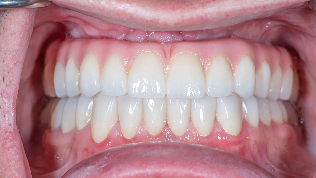 After — Eric's smile transformation