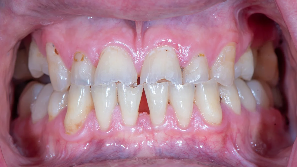 Before — Eric's smile transformation