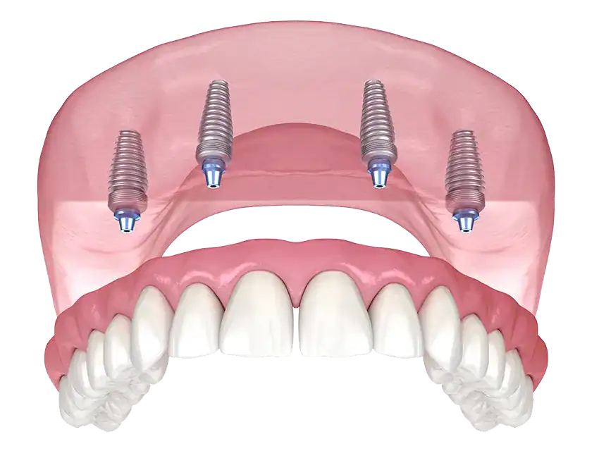 Full-Mouth Dental Implants
