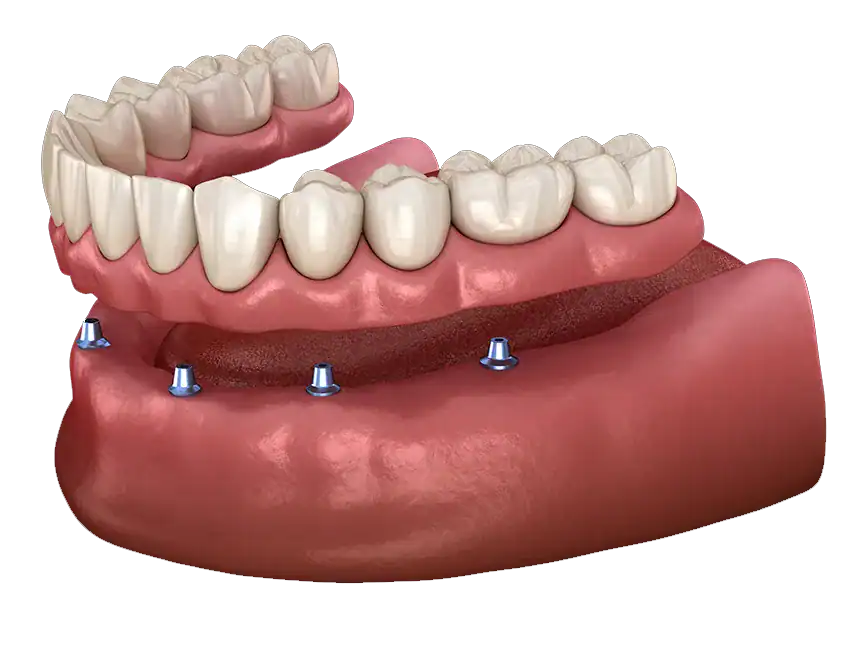Implant-Supported Dentures