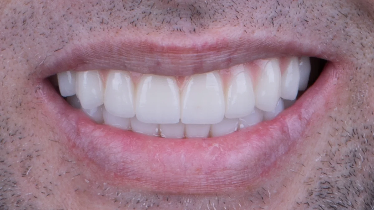 After — Jonathan's smile transformation