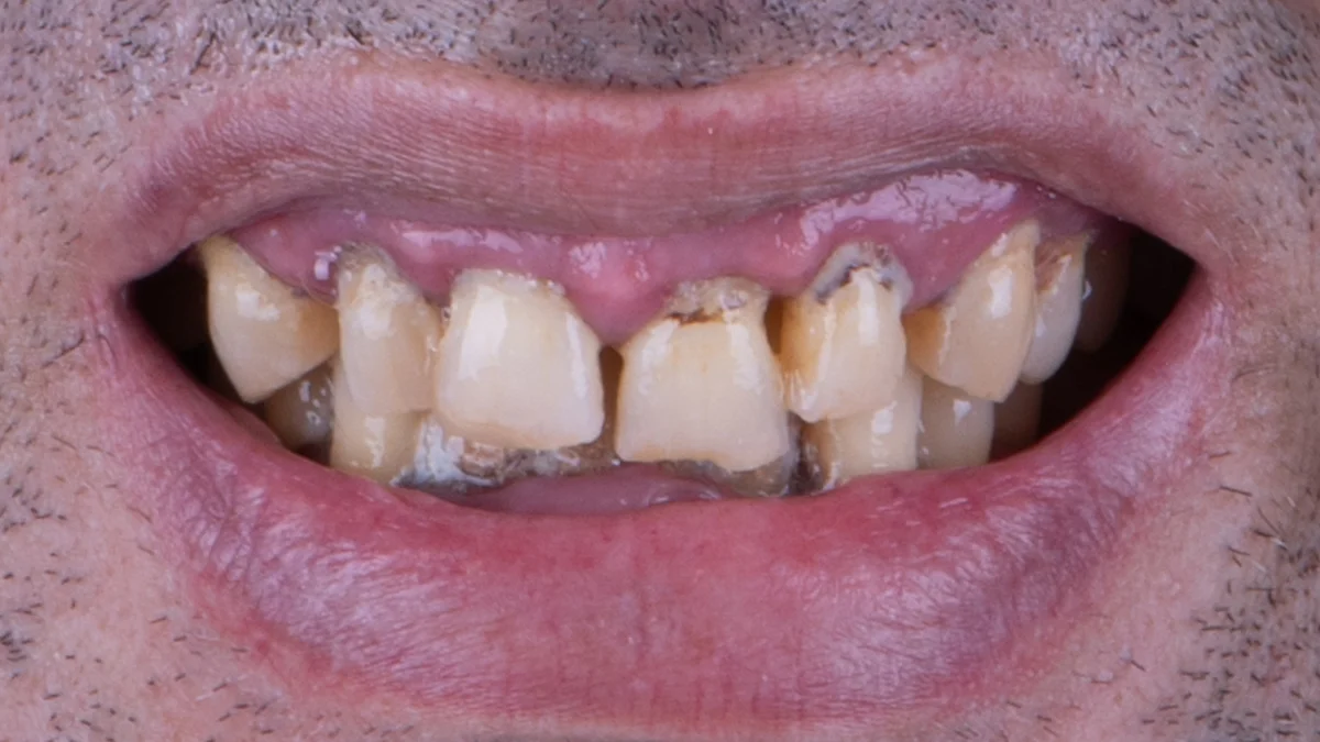 Before — Jonathan's smile transformation