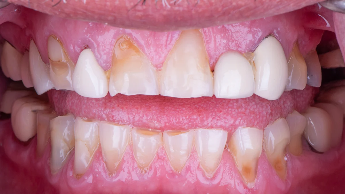 Before — Manuel's smile transformation