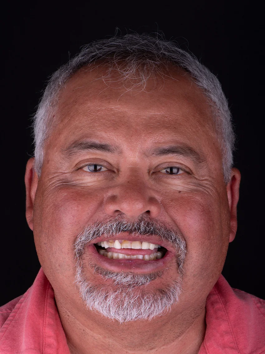 Before — Manuel's smile transformation, portrait