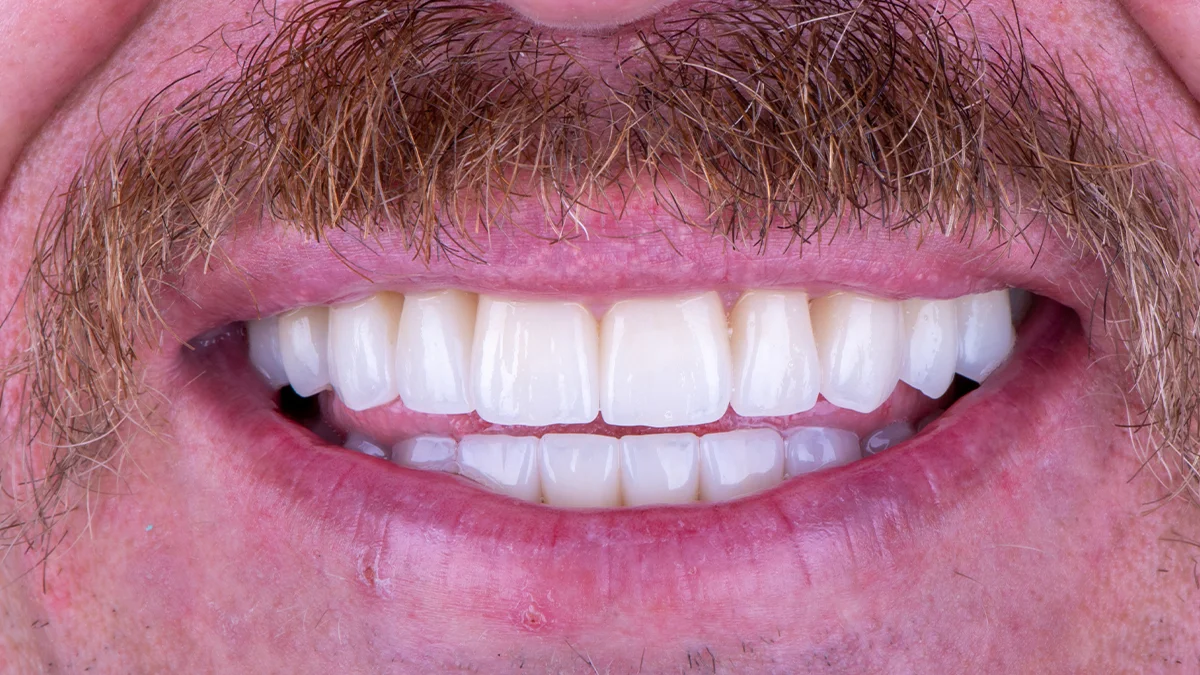 After — Micah's smile transformation