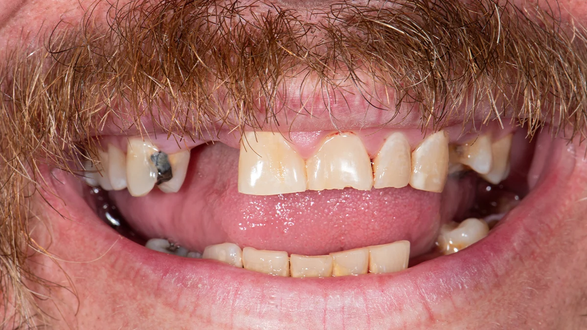 Before — Micah's smile transformation