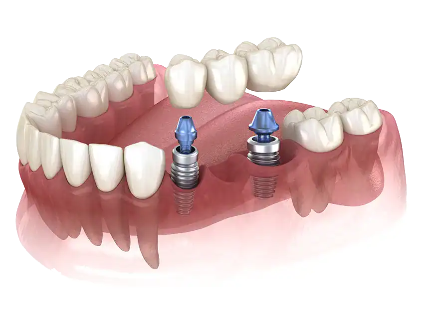 Dental Bridges