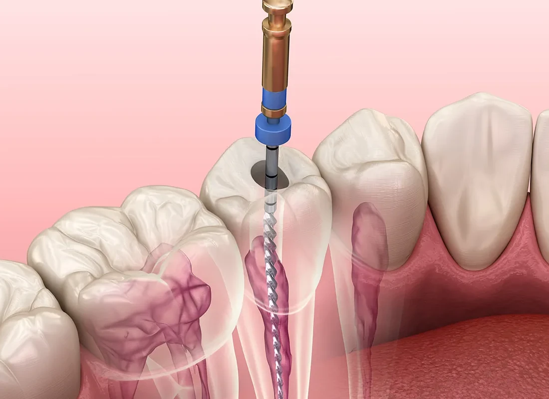 What is Root Canal