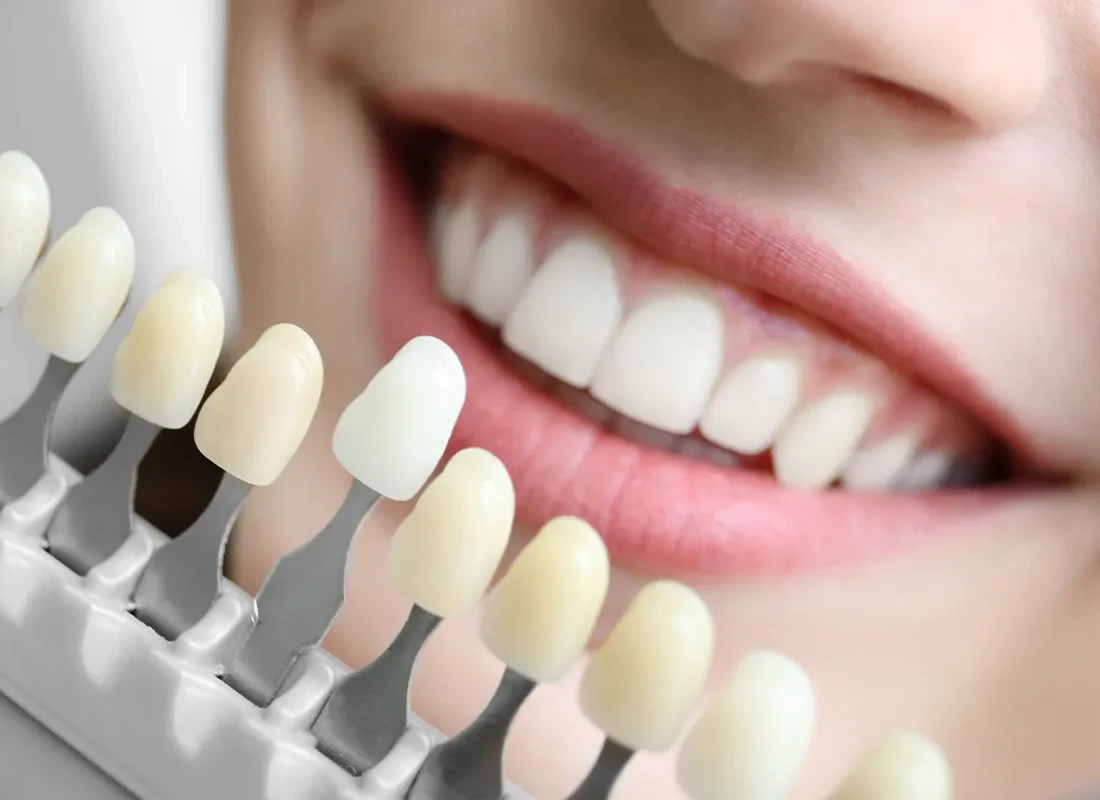 What is Teeth Whitening