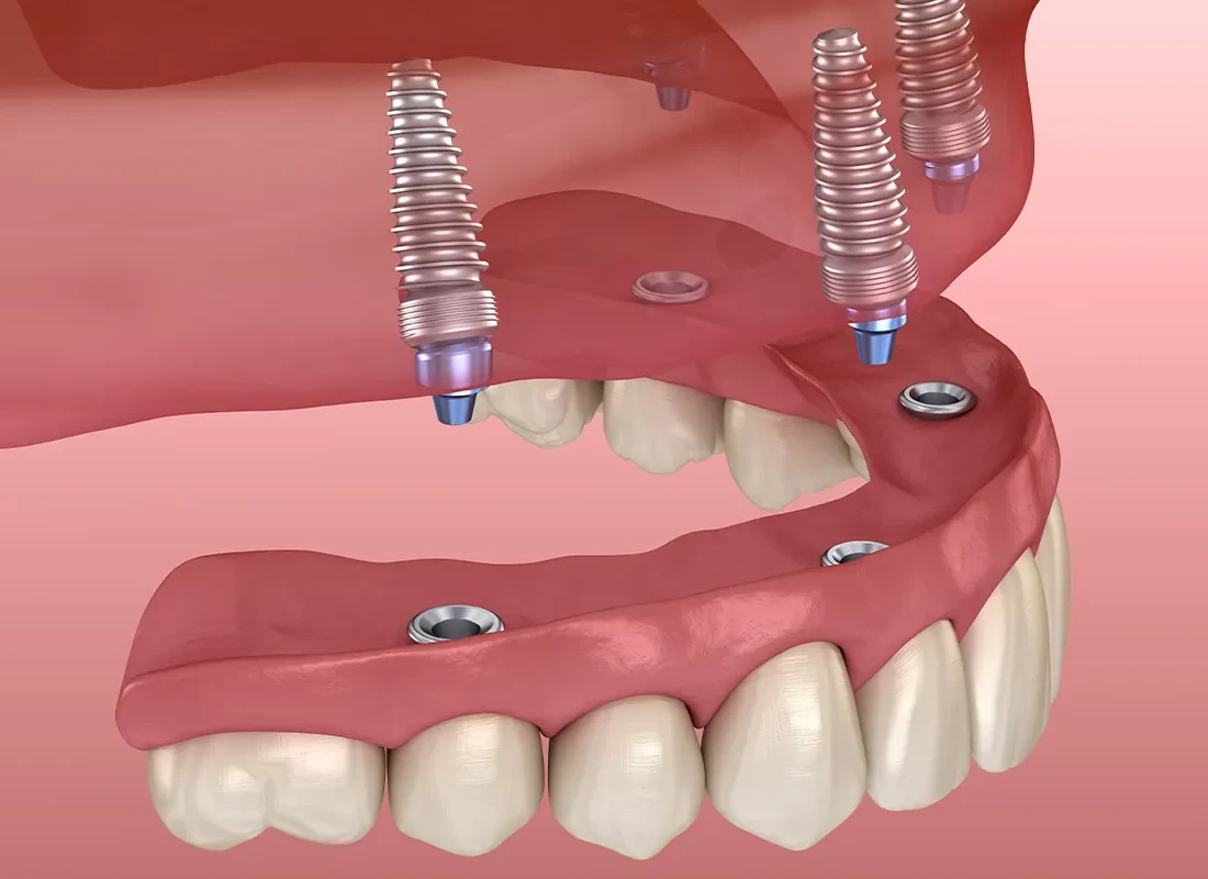 NEXTArc Zirconia