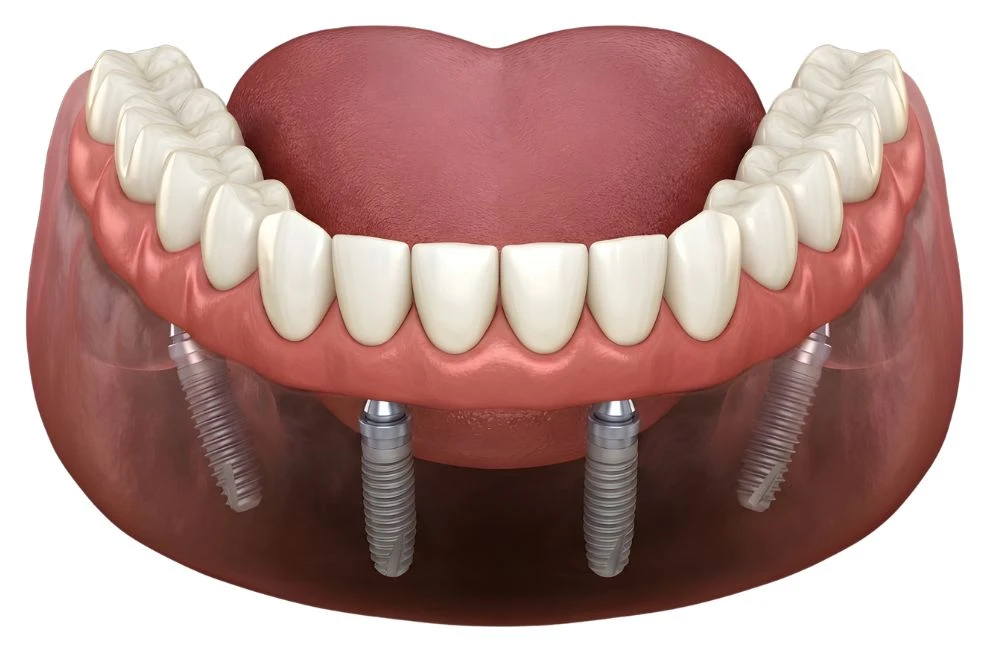 All-on-X Fixed Teeth