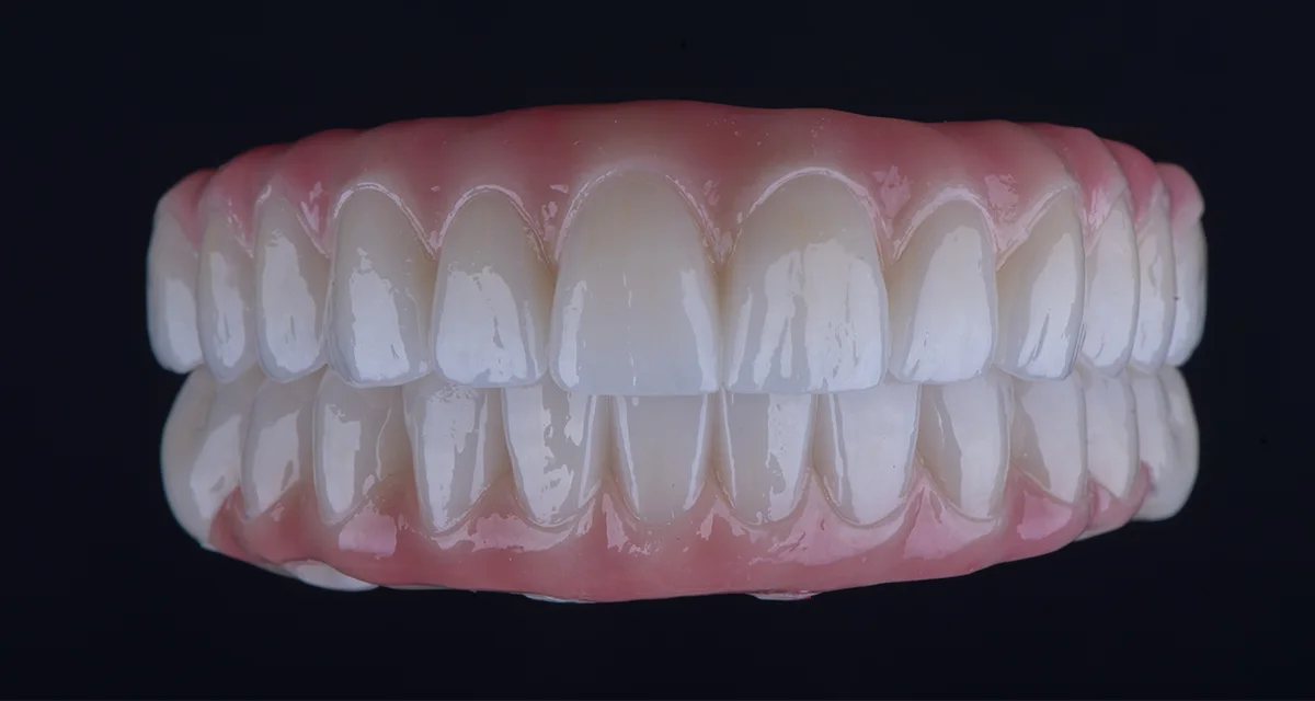 Implant-Supported Full-Mouth Reconstruction