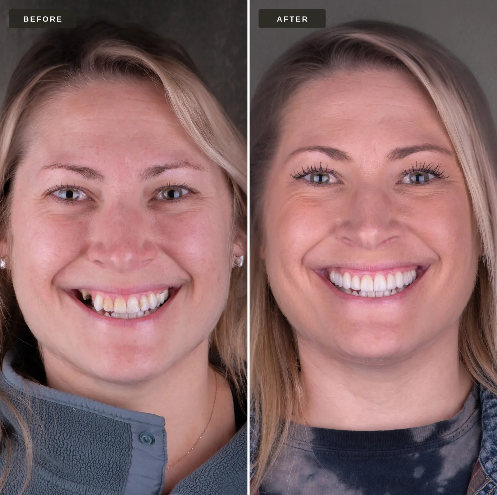 What is Dental Bonding