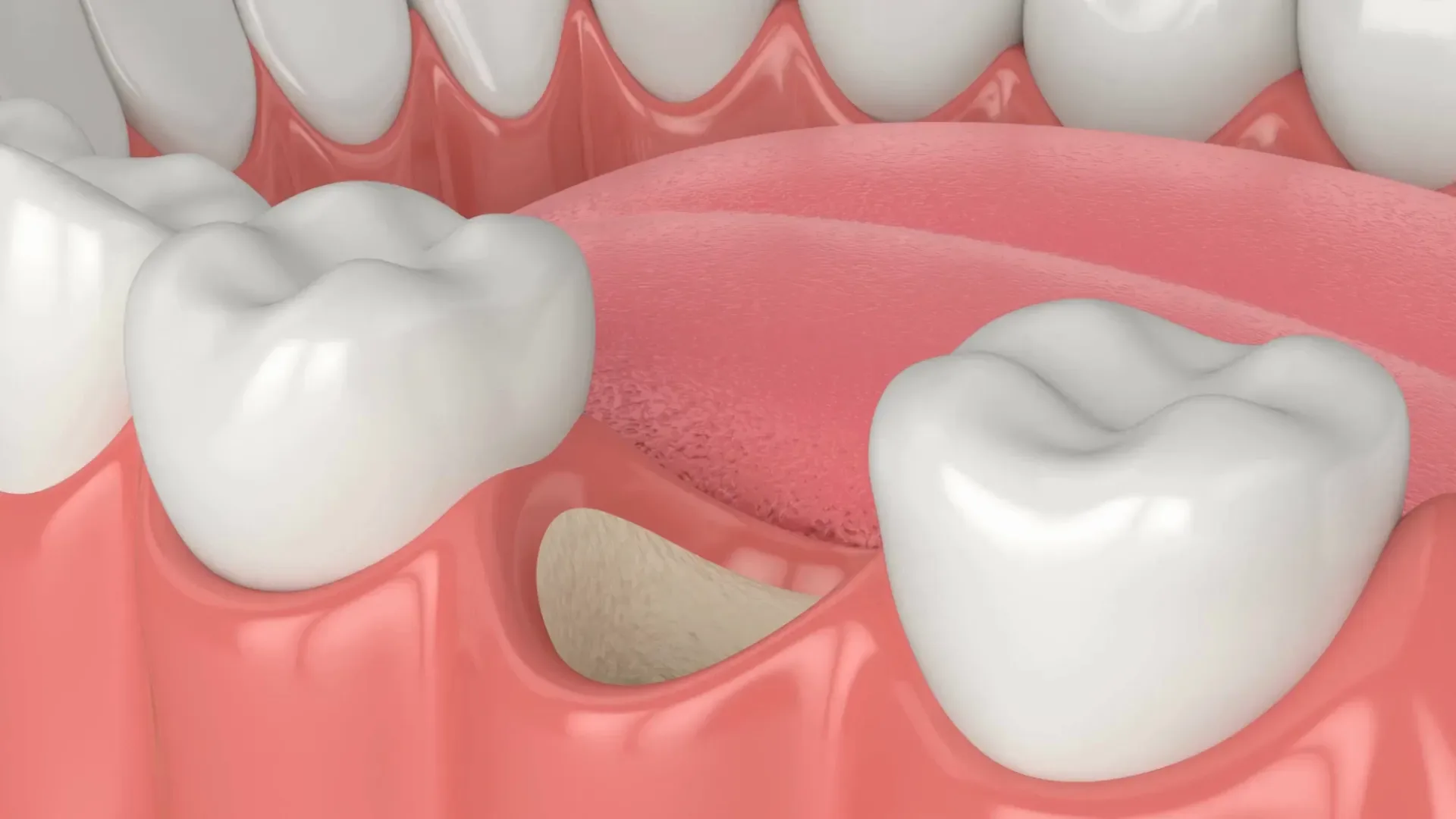 What is Bone Grafting