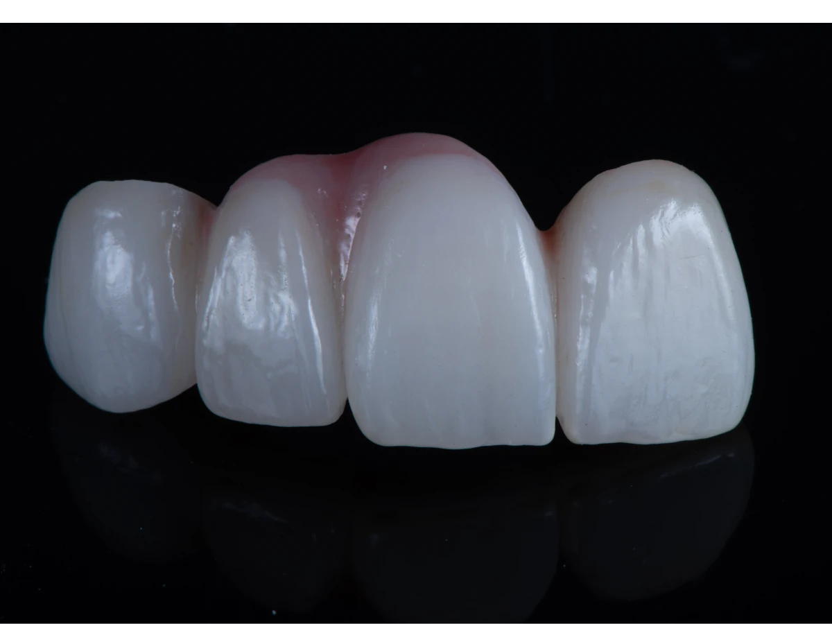 The benefits of Dental Bridges