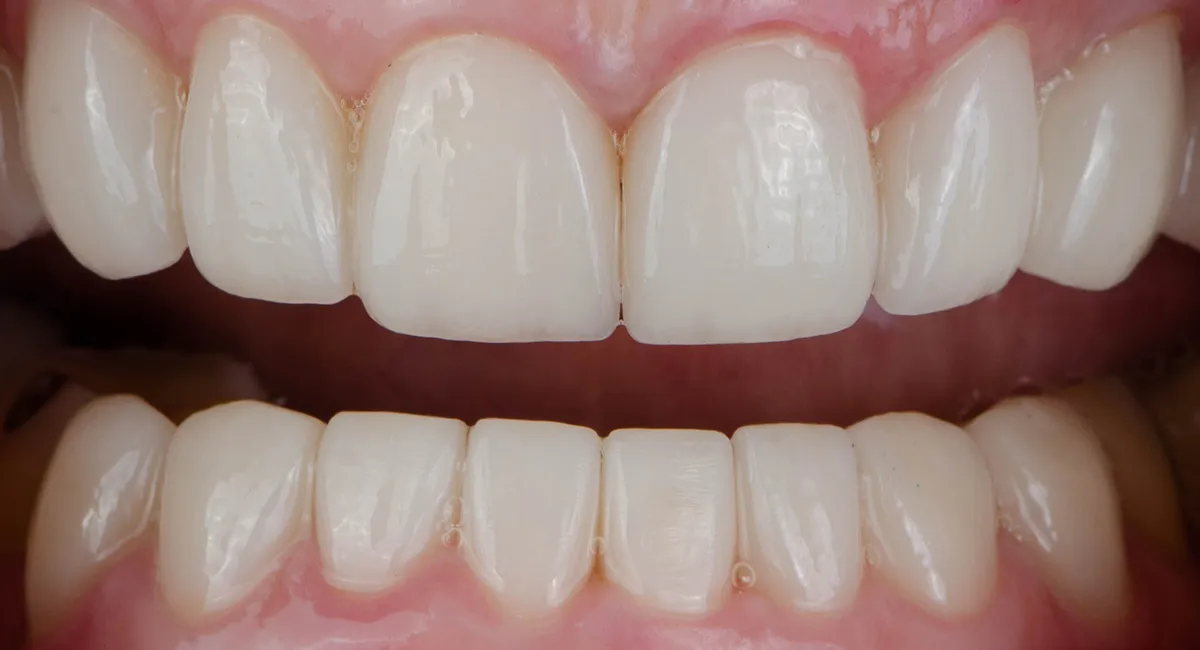 After — Before & after smile transformation