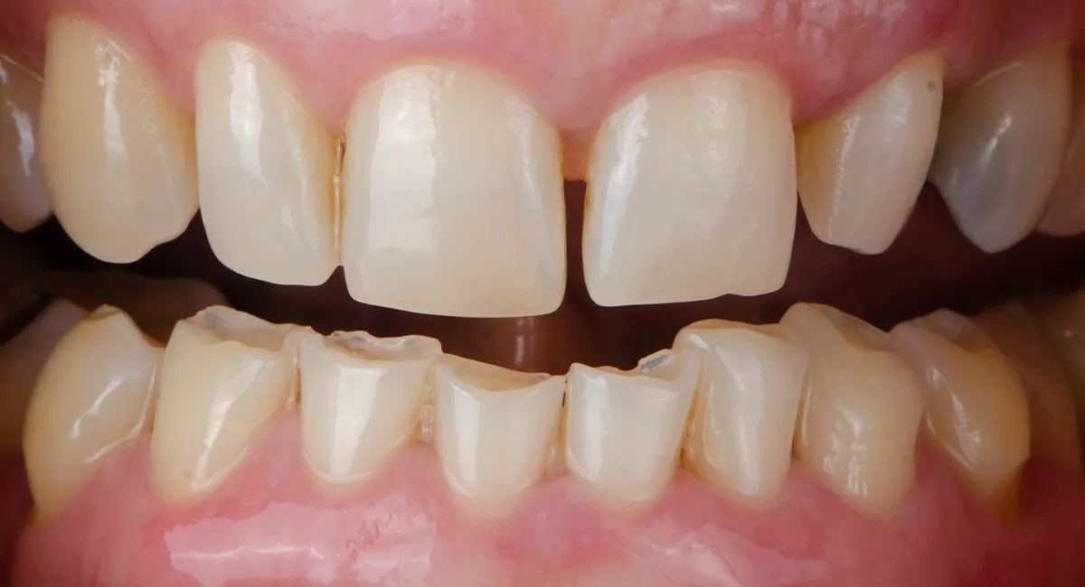 Before — Before & after smile transformation