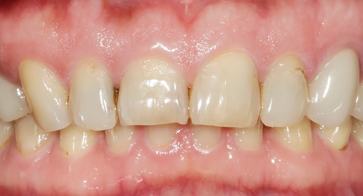 Before — Before & after smile transformation
