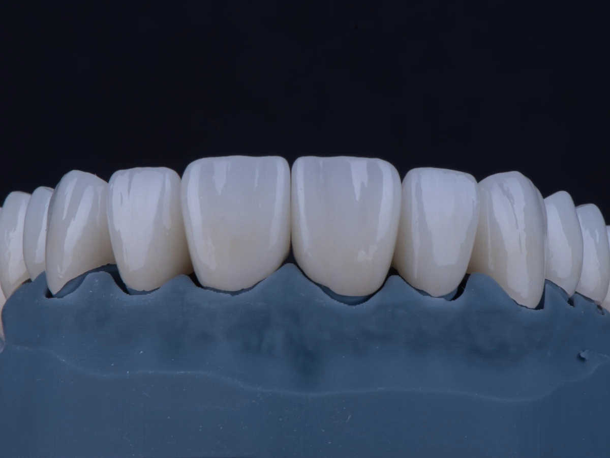The benefits of Dental Crowns