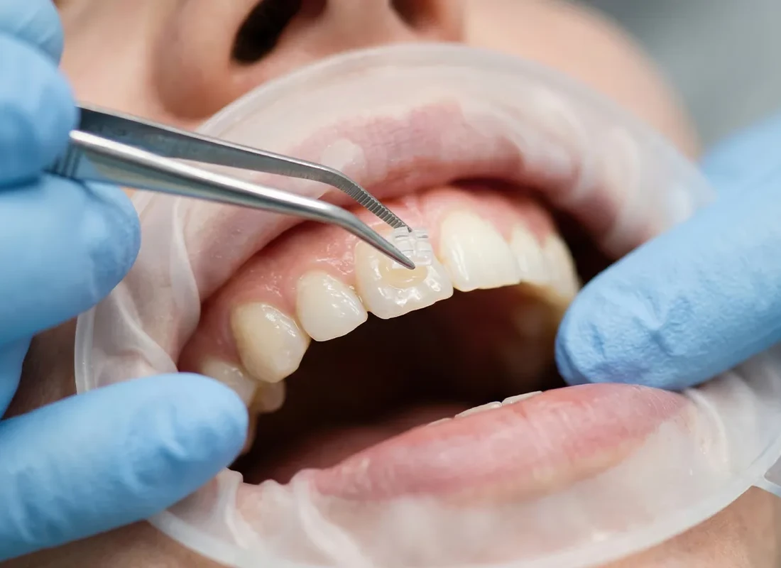 What is Dental Bonding