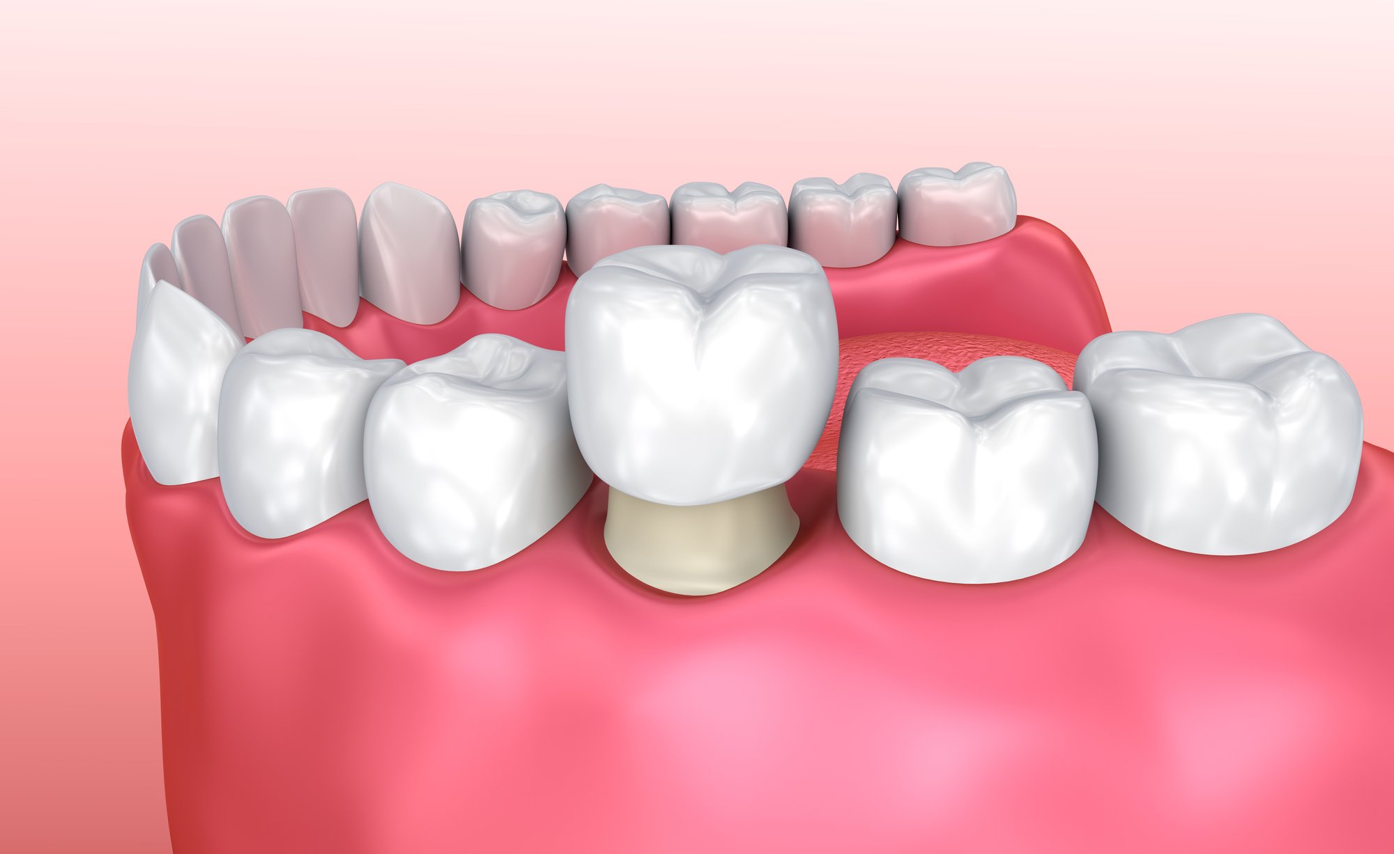 How Many Years Do Dental Crowns Last?