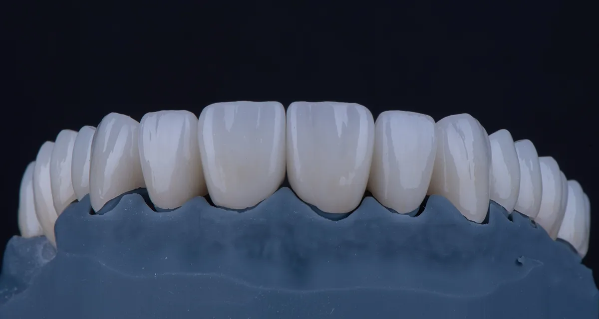 Teeth-Supported Full-Mouth Reconstruction