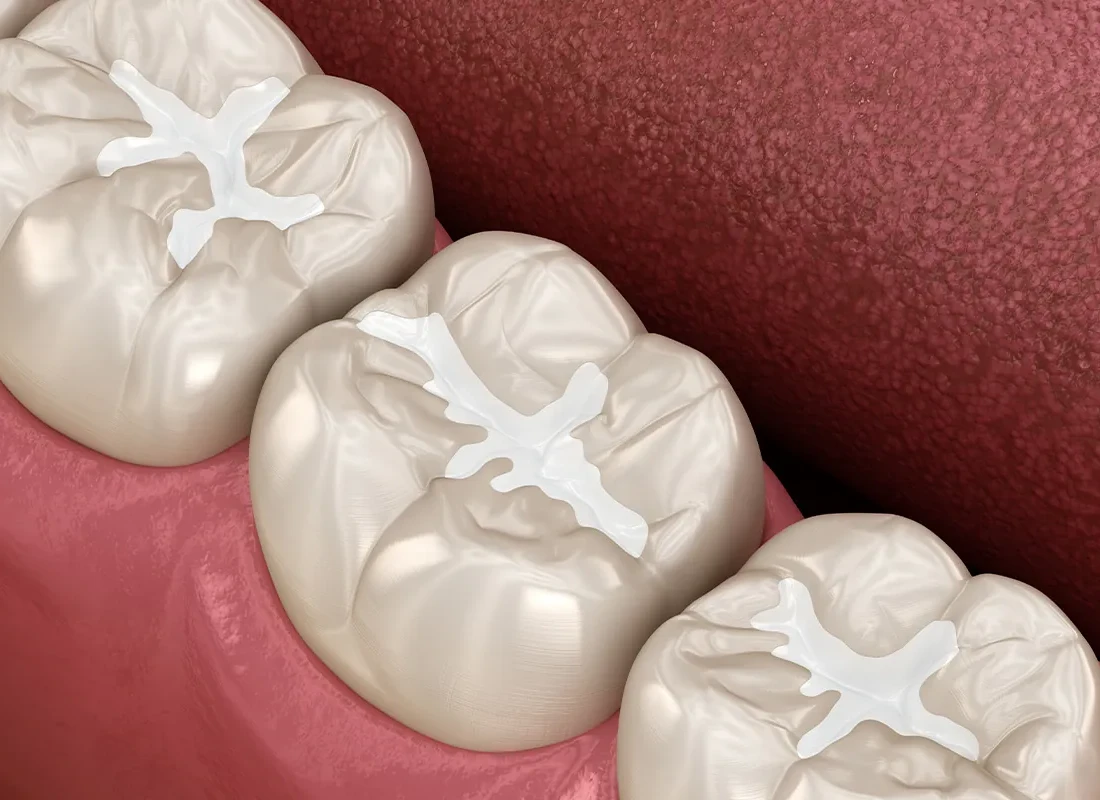 What is Tooth-Colored Fillings