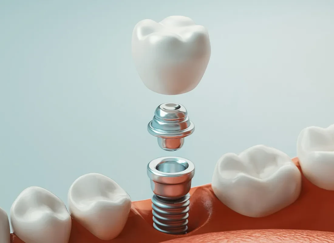 Dental Implants: Understanding Dental Anchors and Their Role
