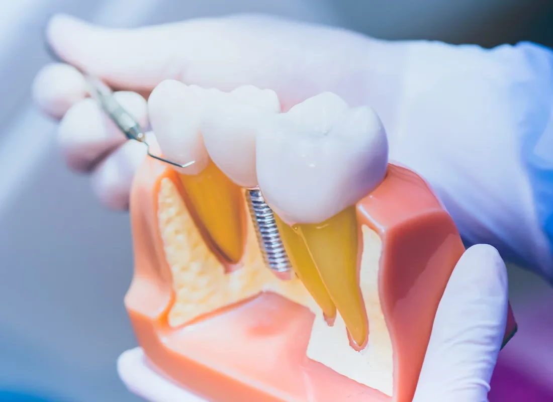 5 Signs You Need a Dental Implant