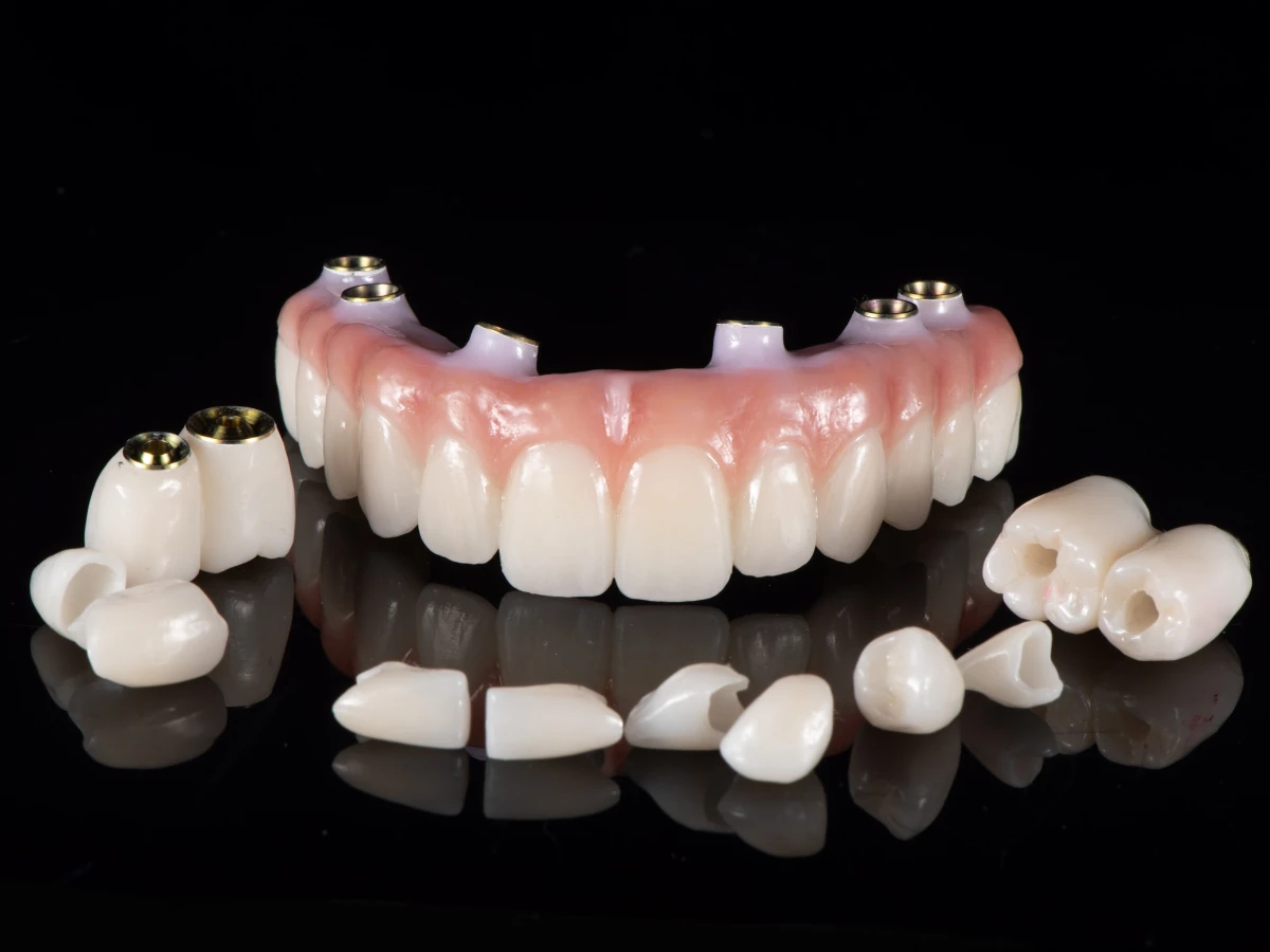 What is Full Mouth Reconstruction