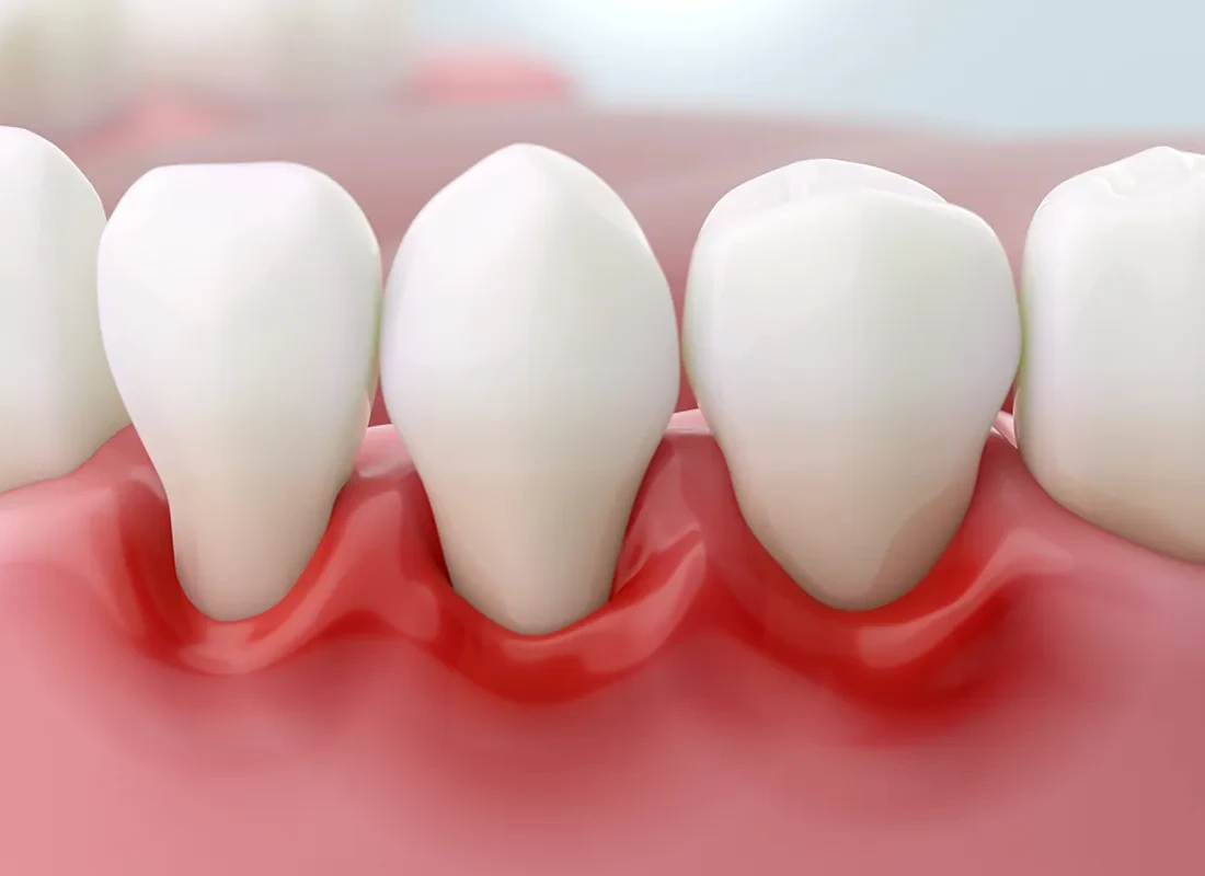 Top 5 Daily Habits for Healthy Gums in Thousand Oaks, CA